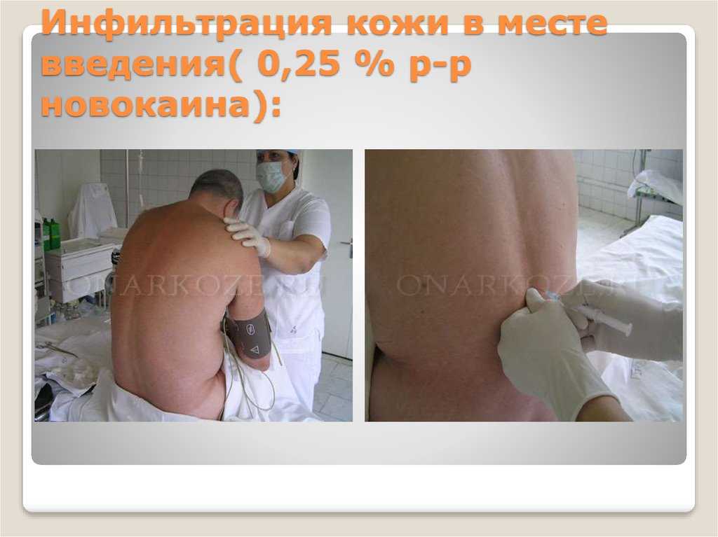 «вред ребёнку», «паралич», «медленные роды»: врач – о мифах эпидуральной анестезии | медицинская россия
