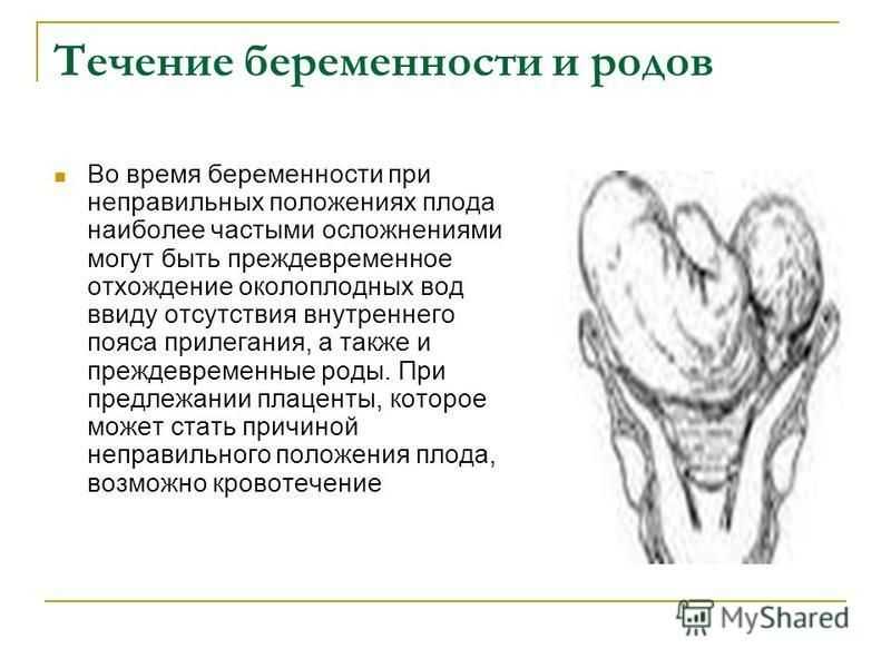 Положение плода при беременности