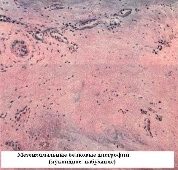 Патологическая анатомия мезенхимальные дистрофии (лекция). практическое задание. медицина, физкультура, здравоохранение. 2008-11-06