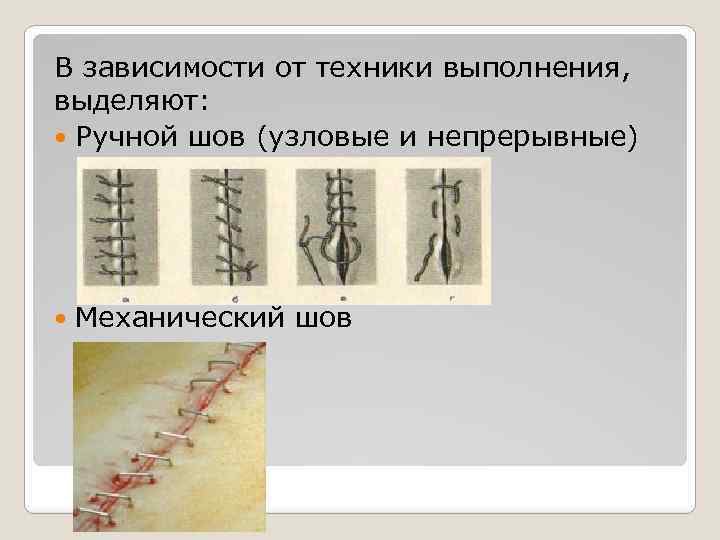 Внутрикожный косметический шов. виды хирургических швов и техника их наложения. отличие косметического шва от обычного