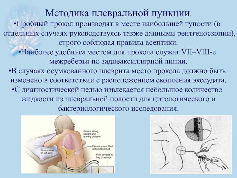 Торакоцентез (плевроцентез): показания, техника выполнения