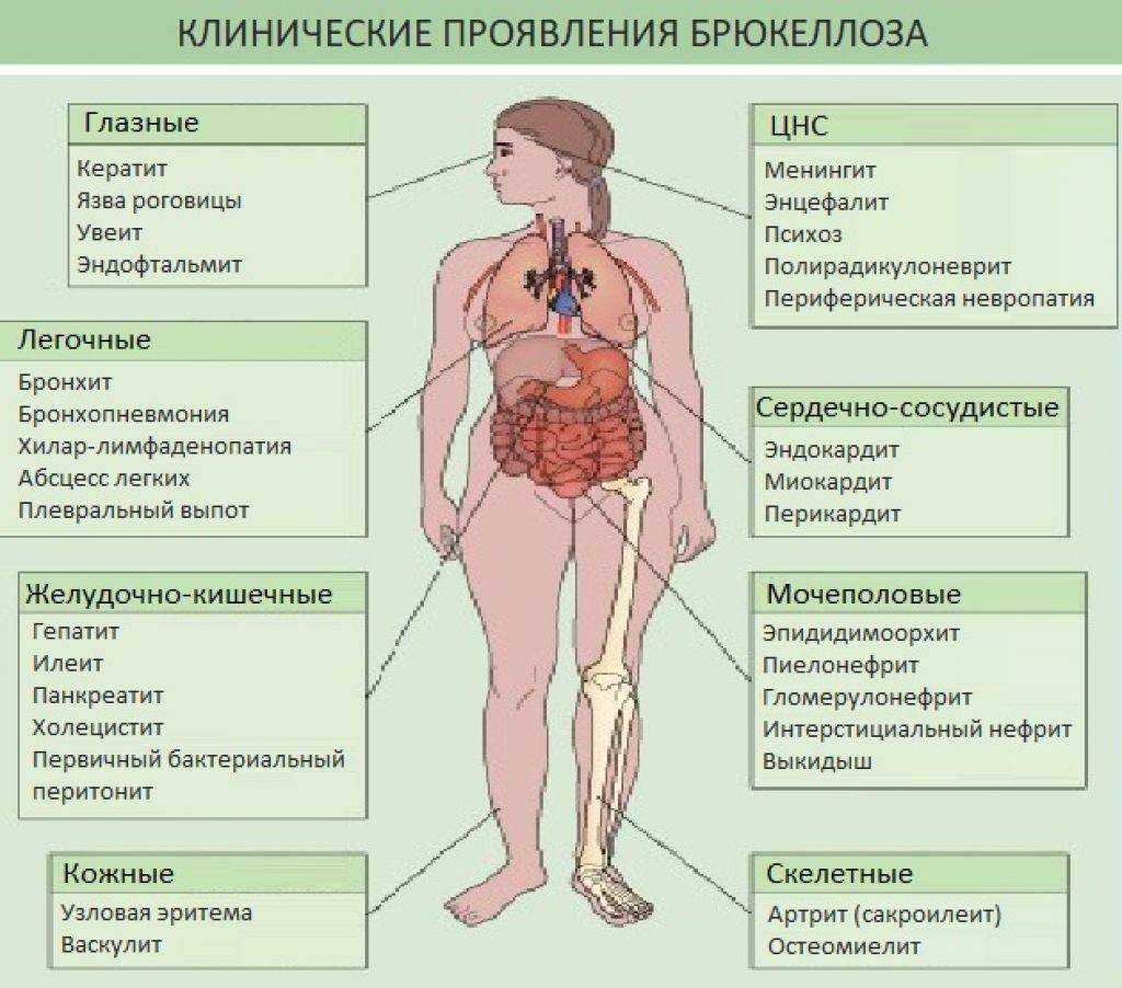 Бруцеллез - причины, симптомы, формы и диагностика