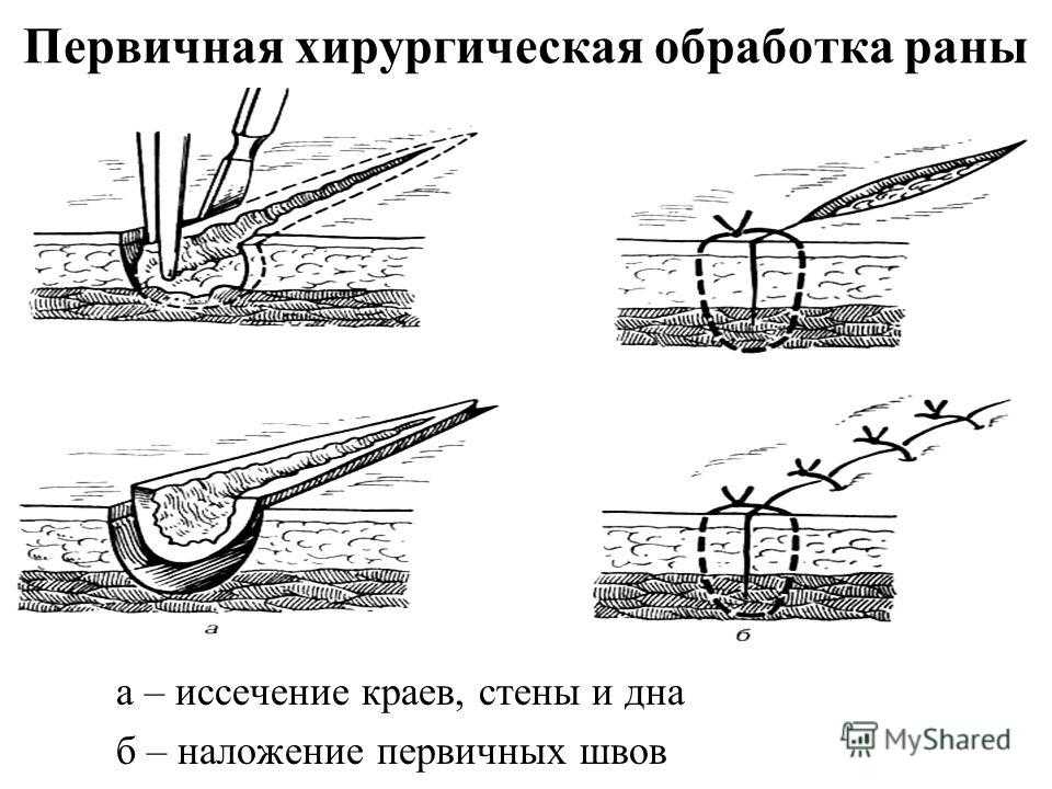Хирургические швы: виды, техника выполнения