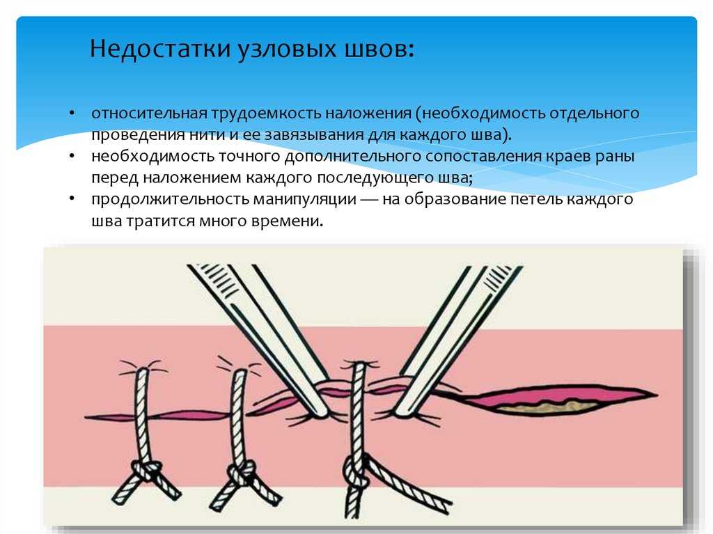 Наложение швов: необходимая подготовка и методика проведения | услуги клиники «проксима» (г. сочи)