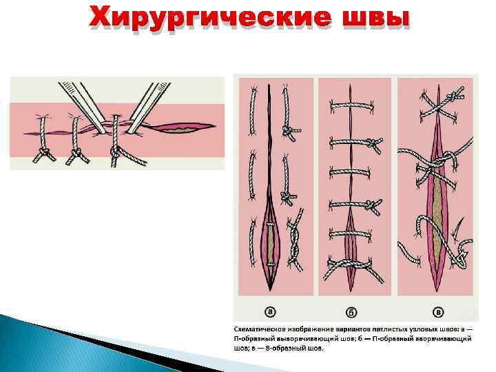 Хирургические швы: виды, техника выполнения
