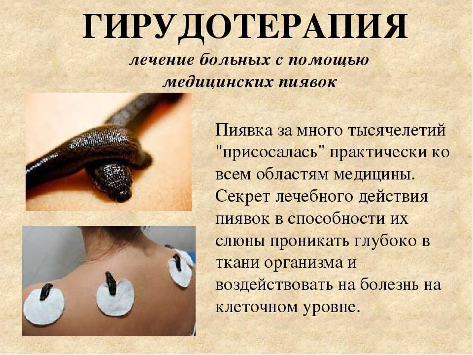Пиявки, опасные для человека