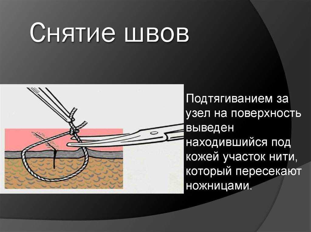 Сколько заживают швы после операции?