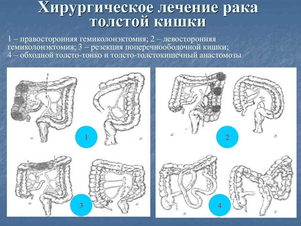 Выпадение прямой кишки