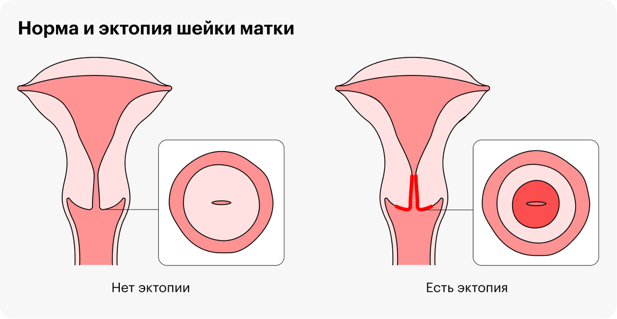 Эрозия шейки матки