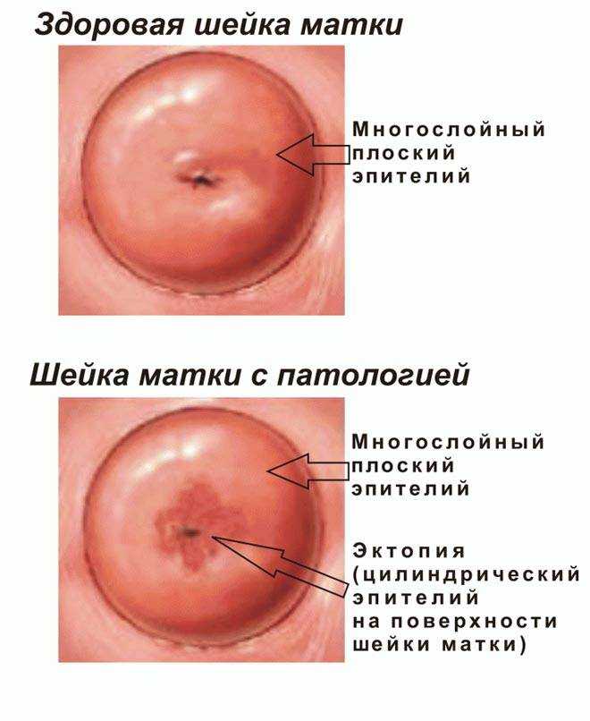 Эрозия шейки матки: симптомы, диагностика, лечение