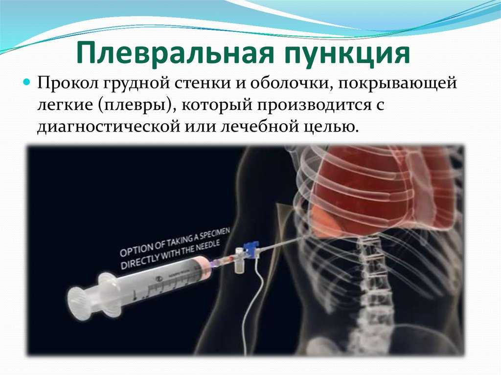 Методика проведения торакоцентеза