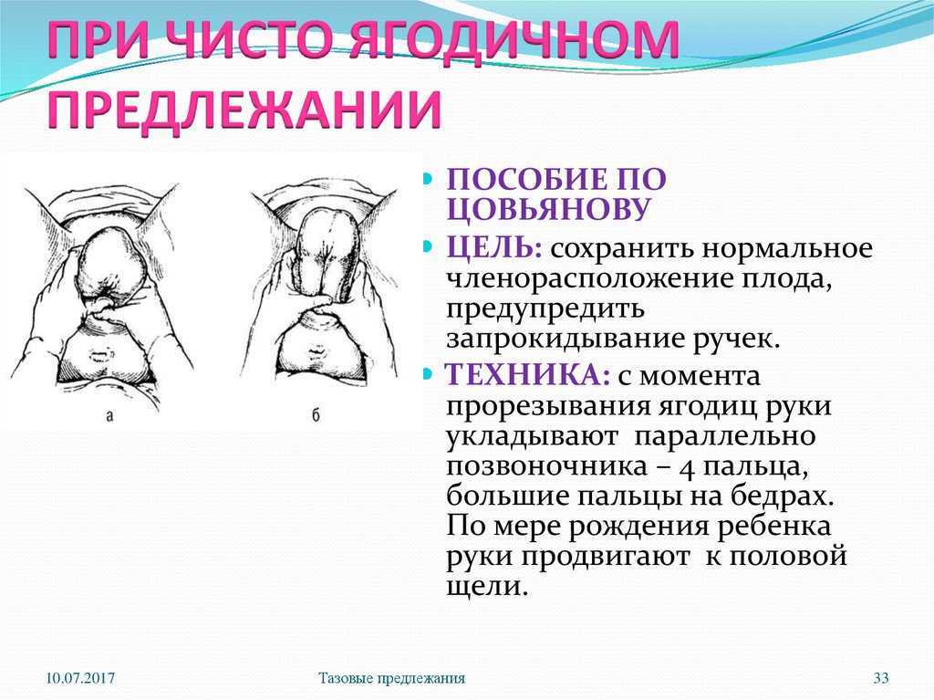Головное предлежание плода при физиологических родах