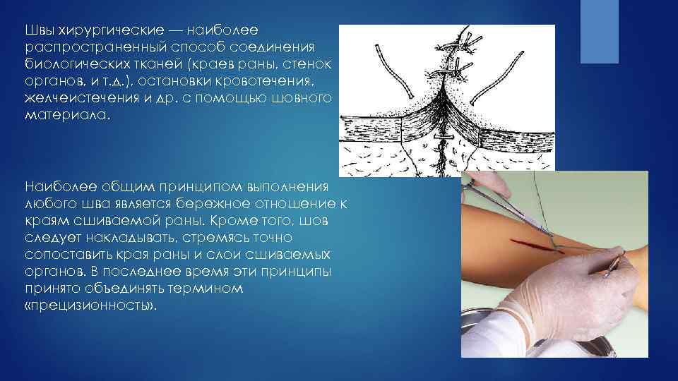 Самые распространенные способы наложения хирургических швов